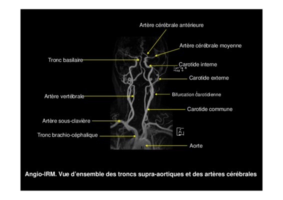 artere cerebrale anterieure Book